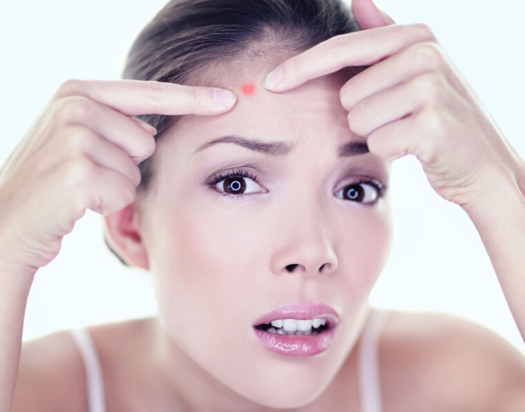 Why Your Pimple Won't Go Away? How to Treat Acne?