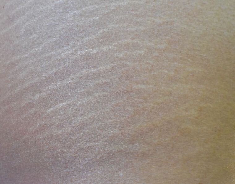 Fade Stretch Marks with Rosehip Oil